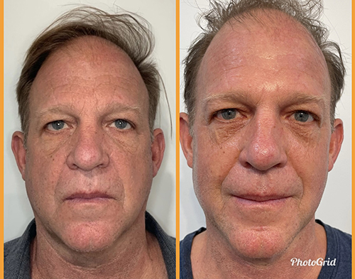 prp-facial-before-and-after